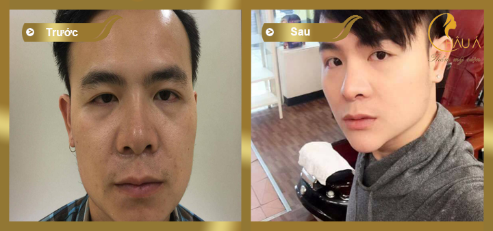 hình ảnh trước và sau khi nâng mũi bọc sụn tại thẩm mỹ viên Châu Á 3