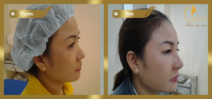 hình ảnh trước và sau khi nâng mũi bọc sụn tại thẩm mỹ viên Châu Á