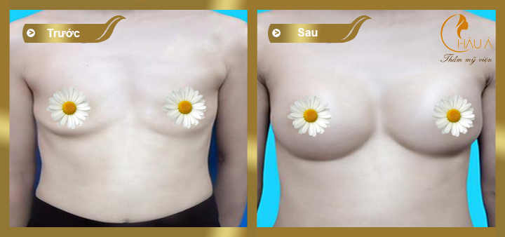 hình ảnh trước và sau khi phẫu thuật nâng ngực bằng túi mentor 2