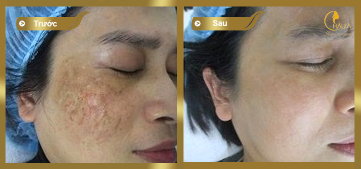 hình ảnh trước và sau khi thực hiện điều trị nám tận gốc bằng peeling 3