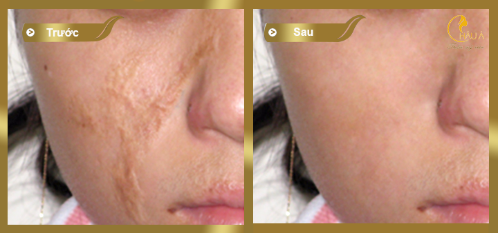 hình ảnh trước và sau khi thực hiện điều trị sẹo lòi bằng co2 practional  tại châu á 1