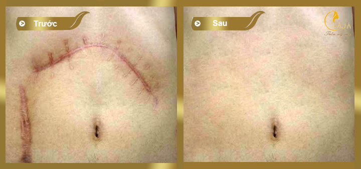 hình ảnh trước và sau khi thực hiện điều trị sẹo lòi bằng co2 practional  tại châu á 2