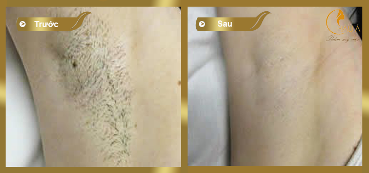 hình ảnh trước và sau khi thực hiện cắt tuyến mồ hôi nách 2