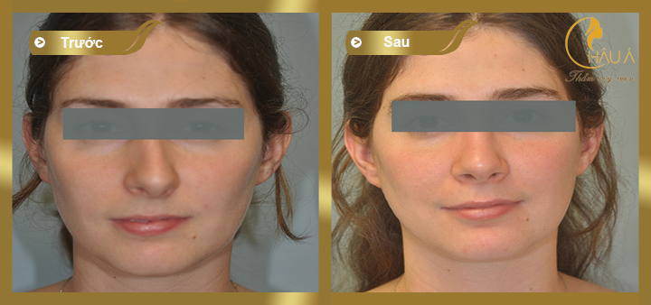 hình ảnh trước và sau khi thực hiện chỉnh sửa mũi hỏng 2