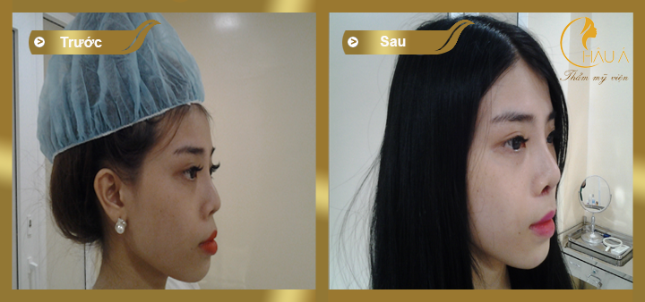 hình ảnh trước và sau khi thực hiện chỉnh sửa mũi hỏng 3