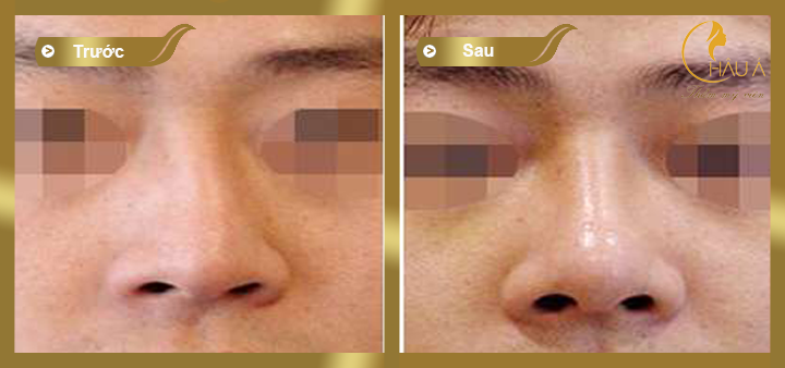 hình ảnh trước và sau khi thực hiện chỉnh sửa mũi hỏng
