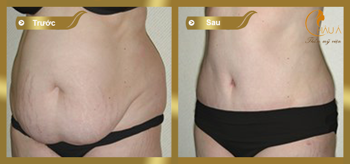 hình ảnh trước và sau khi thực hiện hút mỡ bụng 2