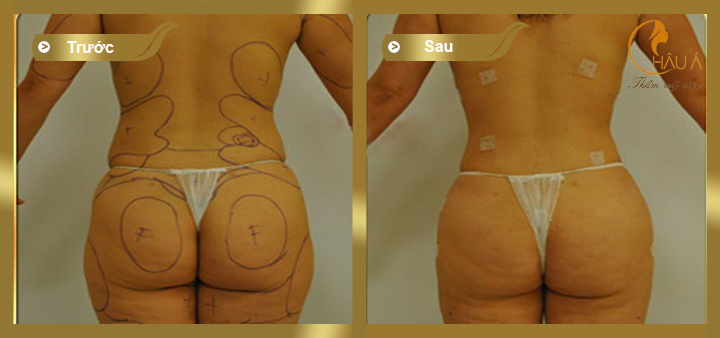 hình ảnh trước và sau khi thực hiện hút mỡ bụng 3