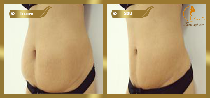 hình ảnh trước và sau khi thực hiện hút mỡ bụng