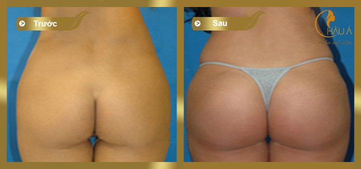 hình ảnh trước và sau khi thực hiện nâng mông nội soi 1