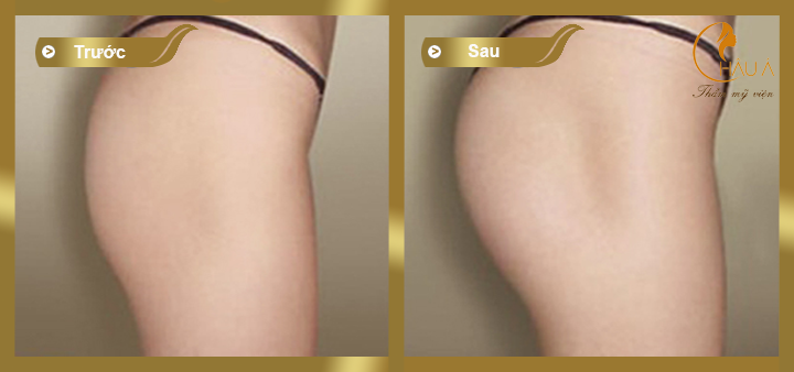 hình ảnh trước và sau khi thực hiện nâng mông nội soi 3