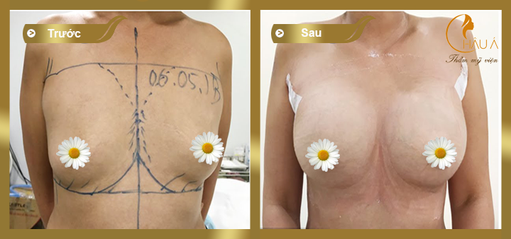 hình ảnh trước và sau khi thực hiện nâng ngực nano tại châu á 1