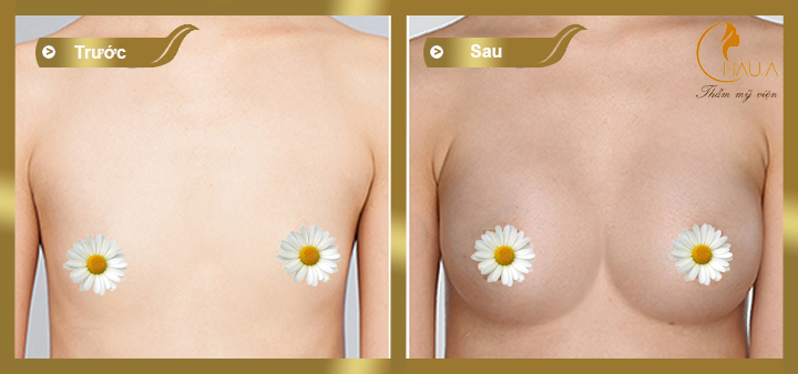 hình ảnh trước và sau khi thực hiện nâng ngực nano tại châu á 3