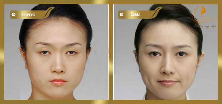 hình ảnh trước và sau khi thực hiện phẫu thuật chữa sụp mí mắt 2