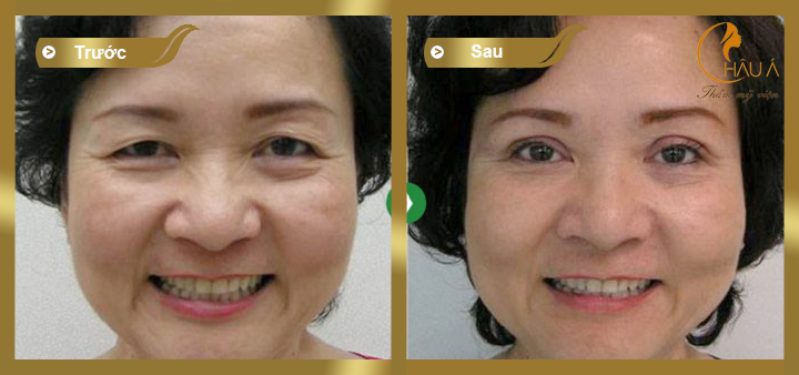 hình ảnh trước và sau khi thực hiện phẫu thuật tạo rộng mắt 3