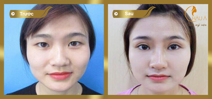 hình ảnh trước và sau khi thực hiện phẫu thuật tạo rộng mắt
