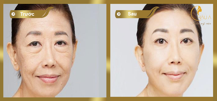 hình ảnh trước và sau khi thực hiện quá trình nâng mũi không phẫu thuật 2