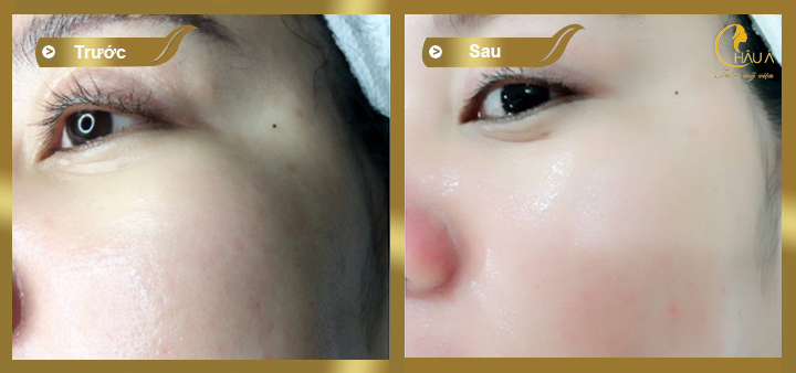 hình ảnh trước và sau khi thực hiện spa da mặt bằng collagen 1
