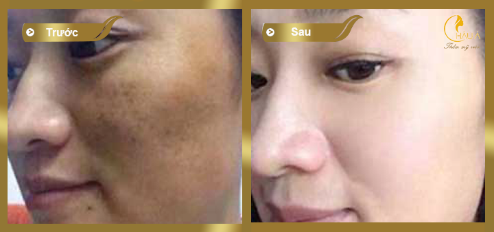 hình ảnh trước và sau khi thực hiện spa da mặt bằng collagen 2