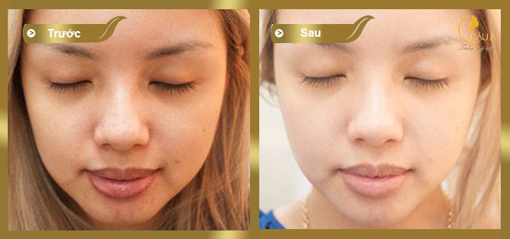 hình ảnh trước và sau khi thực hiện spa da mặt bằng collagen 3