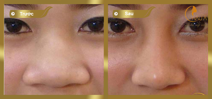 hình ảnh trước và sau khi thực hiện thu nhỏ đầu mũi 2