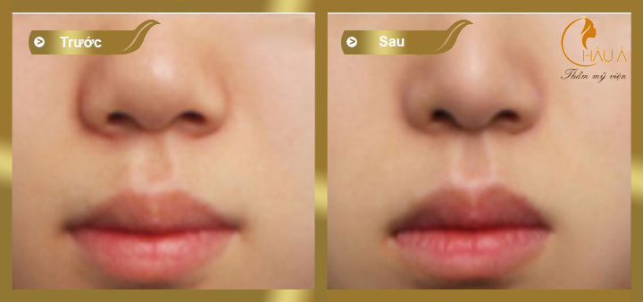 hình ảnh trước và sau khi thực hiện thu nhỏ đầu mũi