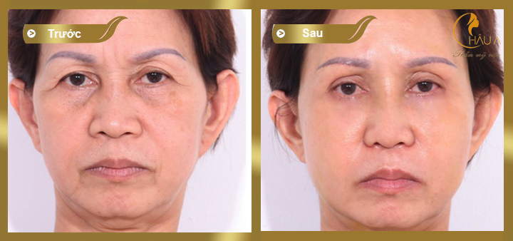 hình ảnh trước và sau khi thực hiện trẻ hóa da bằng laze 3