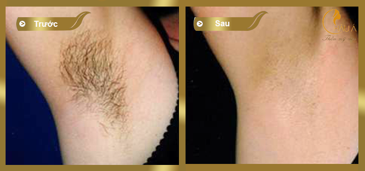 hình ảnh trước và sau khi triệt lông laze tại châu á 1