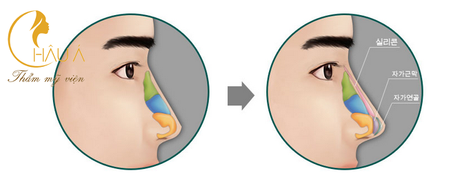 quy trình nâng mũi cho nam tại thẩm mỹ viện châu á