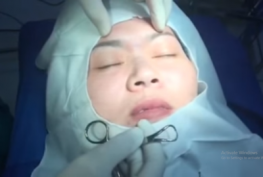 Video phẫu thuật nâng mũi sụn tự thân, bấm mí mắt Hàn Quốc và xử lý sẹo